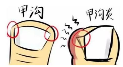 好严重的甲沟炎,离谱的甲沟炎