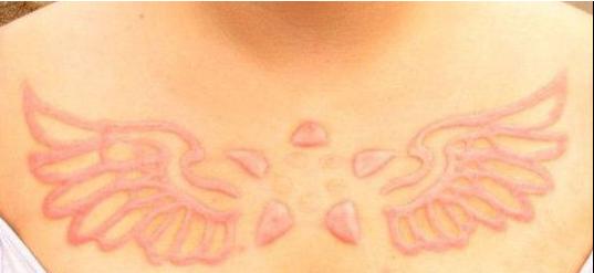 疤痕可以用纹身修复吗,疤痕体质可以用纹身去遮盖疤痕吗