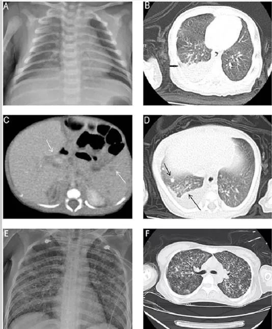 新生儿发热出汗,新生儿腹胀吐黄色液体