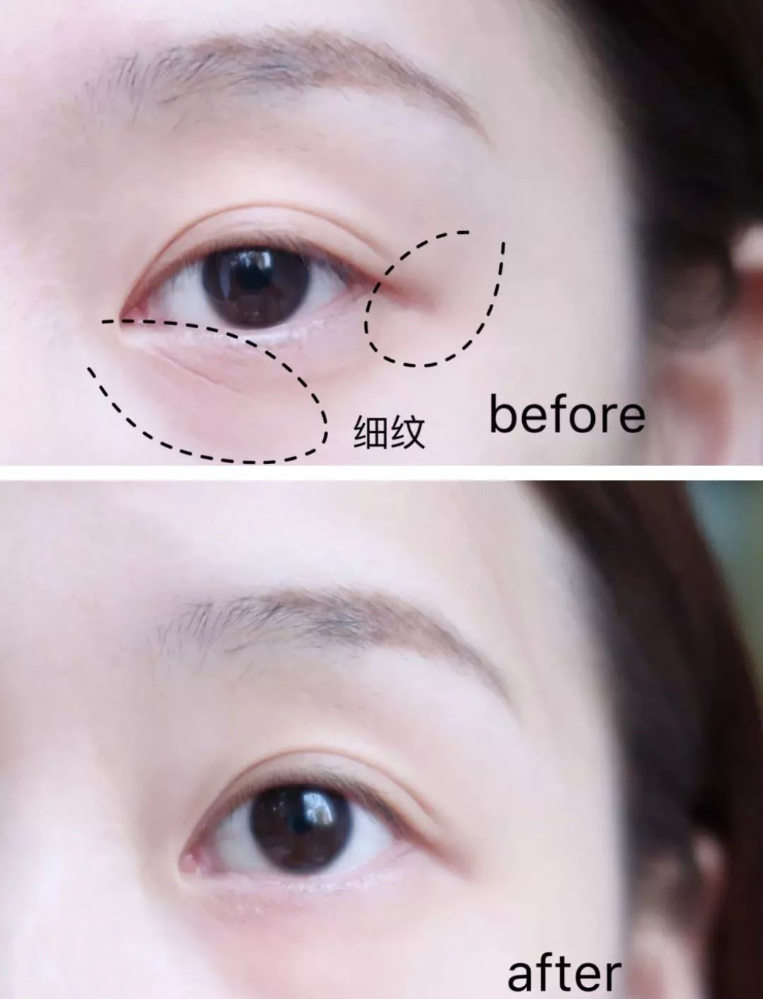 法令纹眼纹一个都逃不掉,法令纹和眼纹怎么才能有效改善