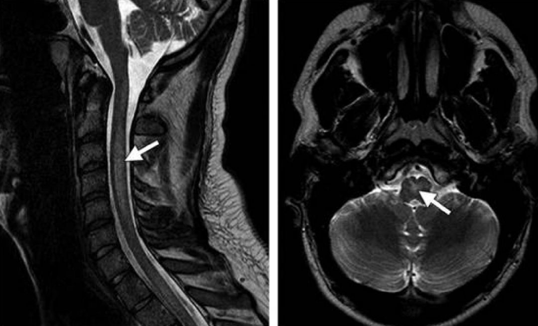 矛盾反应、Carney综合征、脑梗死、笑气中毒丨3分钟读片·第19期