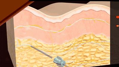 线雕抗衰老的方法,线雕改变了脸型丑死了咋办
