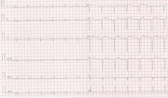 专栏丨贾卫滨：心电图“掉头”现象的定义与诊断特征（1）