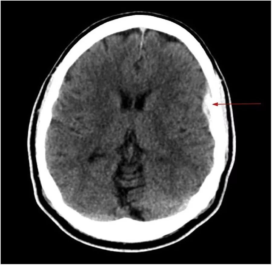 高血压急症的治疗,高血压急症个案