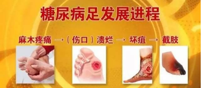 糖尿病足治疗推荐,治糖尿病足的绝好方子