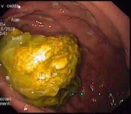 可怕!空腹吃柿子又吃红薯,六旬老人胃里取出“大柿石”