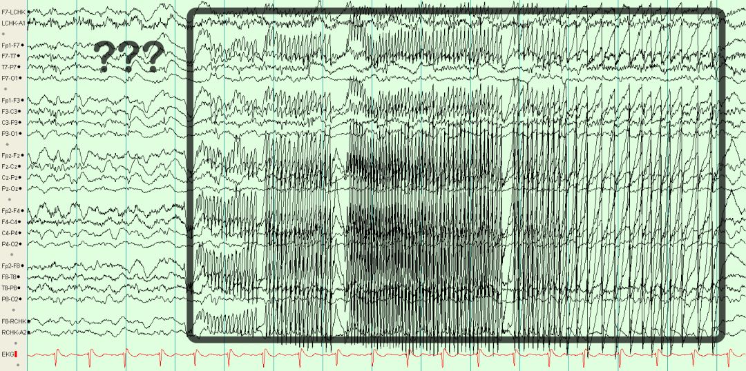 脑电图伪差图,脑电图伪差图谱