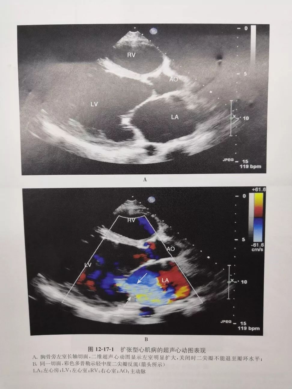 扩心病绝症,扩心病是绝症吗