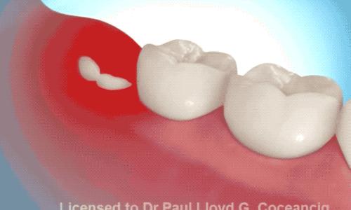 拔智齿的全过程科普,拔智齿细致操作过程