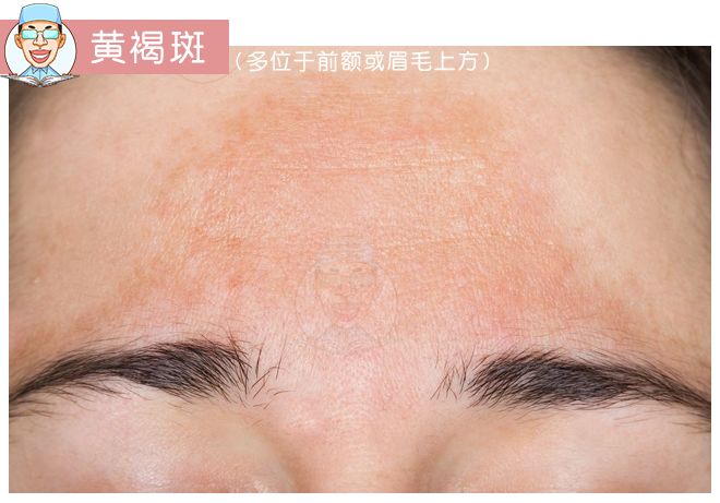 褐青色痣和斑的区别,褐青色痣斑是怎么形成的