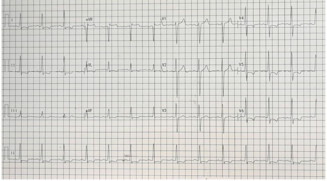 ARNI不仅要用，还要早用