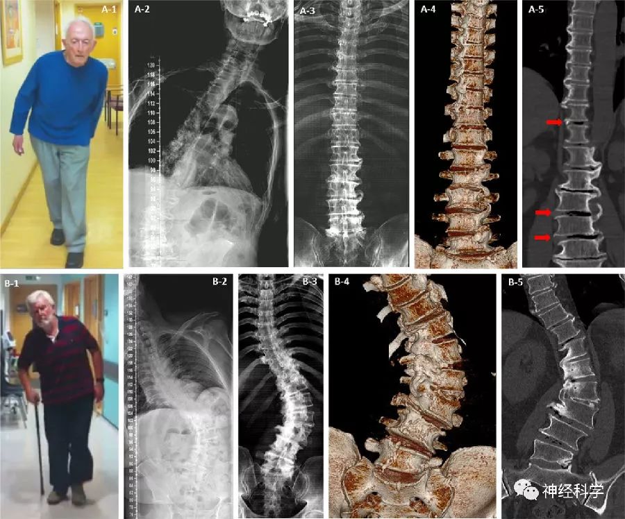 斜月沉沉藏海雾,碣石潇湘无限路——Pisa综合征