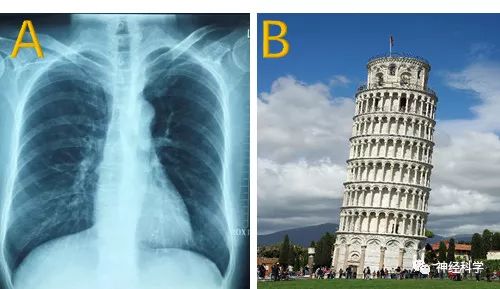 斜月沉沉藏海雾,碣石潇湘无限路——Pisa综合征