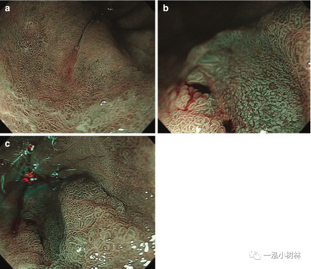 消化道早期癌内镜诊断技巧图谱,早期消化道肿瘤内镜下黏膜剥离术