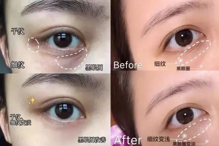 马应龙紧致型眼膜,马应龙眼膜视频