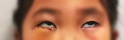 春节寒假高发!4岁女孩玩耍时不小心摔跤,结果右眼眶骨折,眼球不能转动