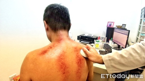 中医刮痧学注意事项,中医基础知识自学入门刮痧