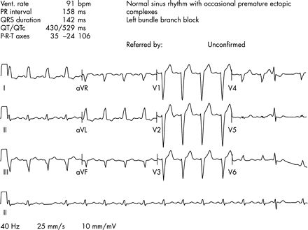 完全性左束支传导阻滞胸痛,左前分支传导阻滞胸痛