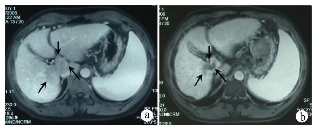 专家访谈肝癌,曾昭冲给谁治疗过