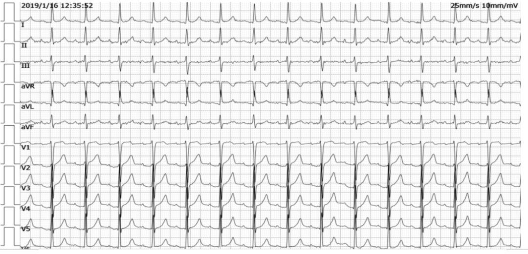 心衰肾衰患者血透有危险吗,血透心衰的治疗