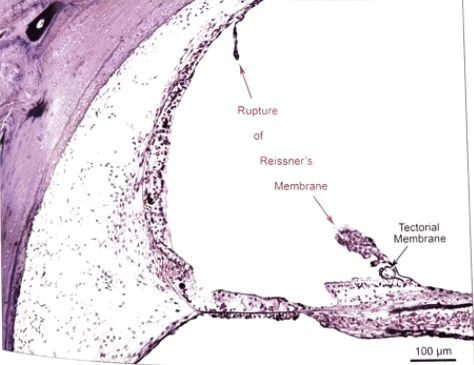 22张图，细说梅尼埃病的组织病理学特点丨“晕”筹帷幄