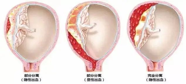 抢救胎盘早剥危急孕产妇,援滇纪实