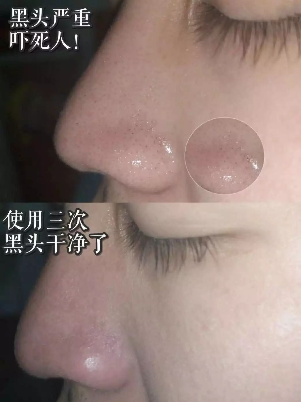 10鍒嗛挓娓呴櫎榛戝ご绮夊埡,榛戝ご绮夊埡鎸ゅ帇娓呯悊姣涘瓟绮楀ぇ