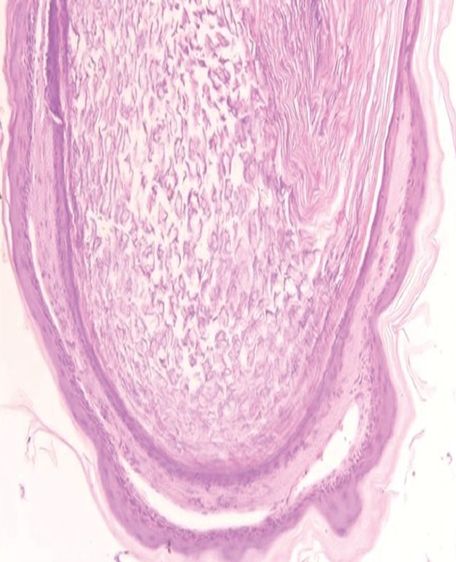 六个月宝宝粟丘疹,婴儿长粟丘疹是因为母乳吗