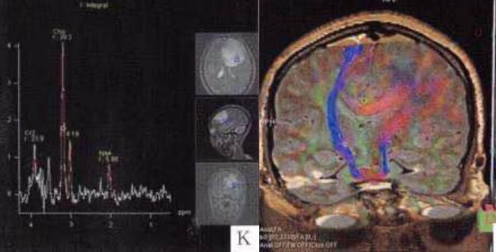 枫糖尿病、血管型梅毒、Hopkins综合征、Susac综合征丨3分钟读片·2期