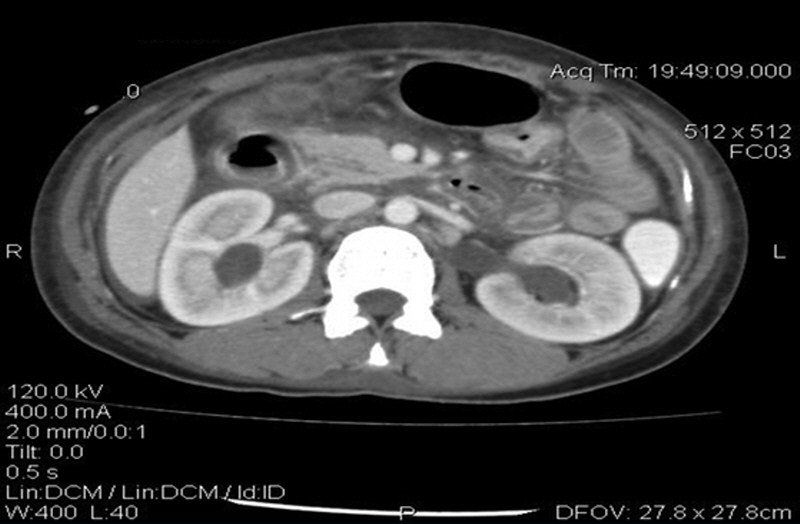 女性腹痛常见疾病,腹痛伴有腹水怎么回事