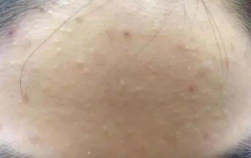 脸上长闭口怎么办教你正确去闭口,长闭口的正确消除方法脸颊