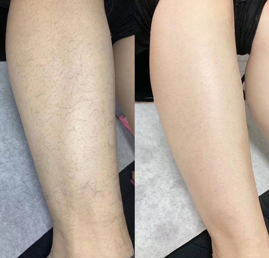 399元永久脱毛,618精选脱毛好物