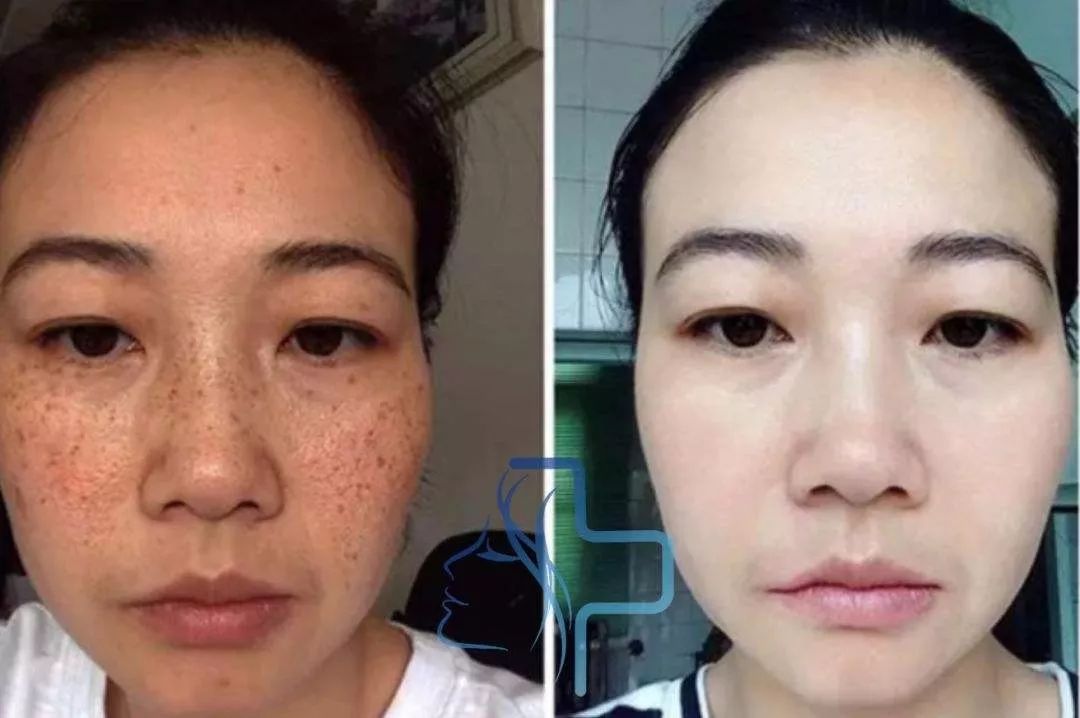 长期补充胶原蛋白的人怎么样了,长期喝胶原蛋白的人最后怎么样了