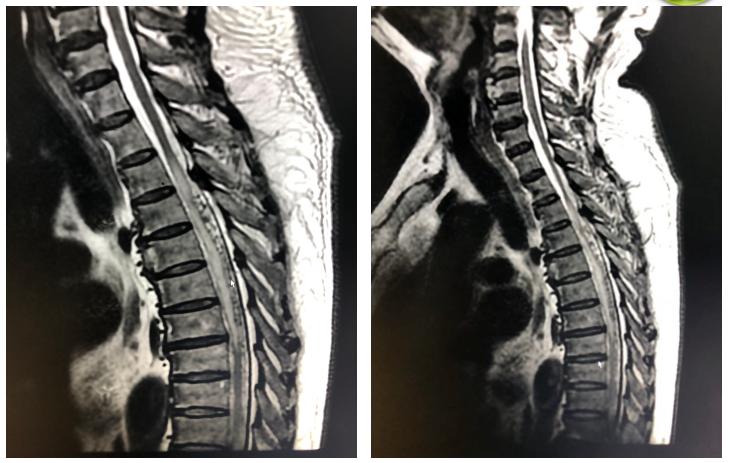 慧眼识传说:MRI的“白萝卜和黑芝麻”影像征丨病例探究