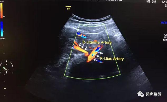 胎儿宫内窘迫通过什么检查出来的,胎儿宫内缺氧的超声视频