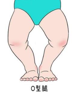 儿子遗传妈妈的o型腿怎么办,遗传孩子o型腿几岁干预比较好