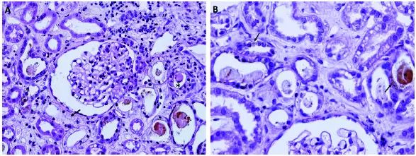 胆汁管型肾病，你听说过吗？