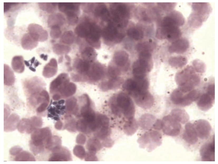 尿液中有肉眼可见杂质正常吗,尿液有形成分检查细菌偏高