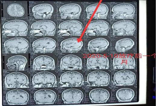 湖南一大爷2月前头痛欲裂2月后行走如常，陀螺刀解患者难题