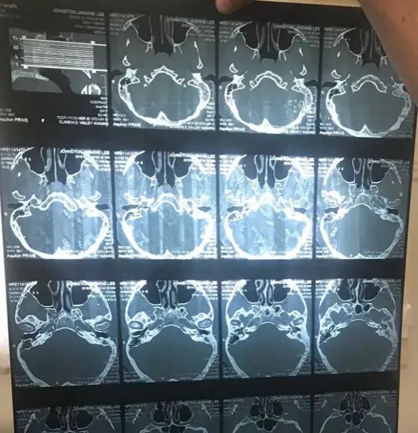 棉签抠耳朵导致癫痫,警惕掏耳朵竟暗藏这些危险