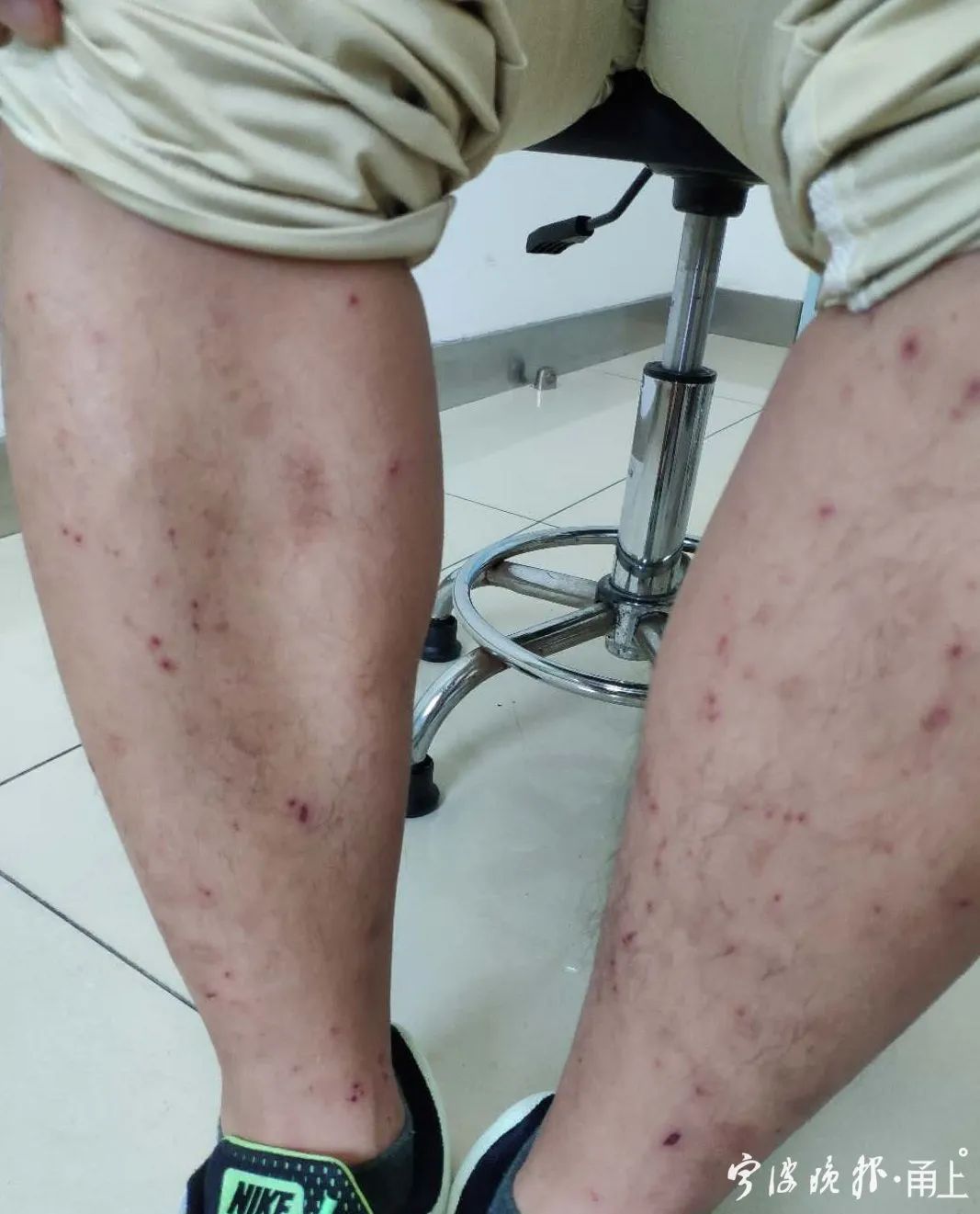 初中生身体上有小红点很痒,女生突然起红色的疹子