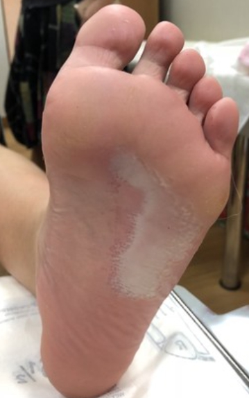 20条咸鱼上身！17岁男脚底长「白蒸蛋」医一看吓坏