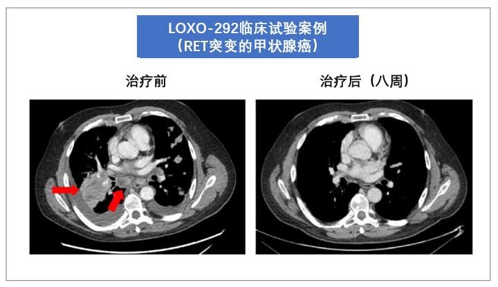 国内首款RET靶向药 (ret靶向药仿制版)