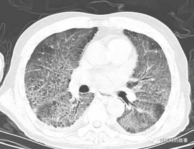输盐水的目的,生病输盐水有什么用