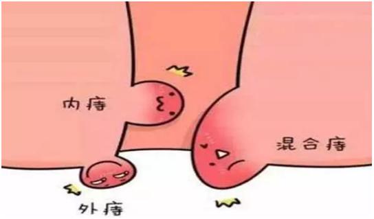 超声多普勒引导下痔疮手术多少钱,超声多普勒治疗痔疮优缺点