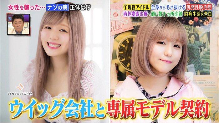 日本16岁美少女偶像歌手脱发到光头！“沦为”假发模特后的她，没有忘记自己甜美的笑容...