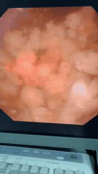 13个月宝宝反复发烧怎么回事,13个月宝宝经常发烧是什么原因