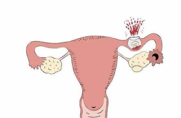 妇产超声科普知识,宫外孕和异位妊娠的区别