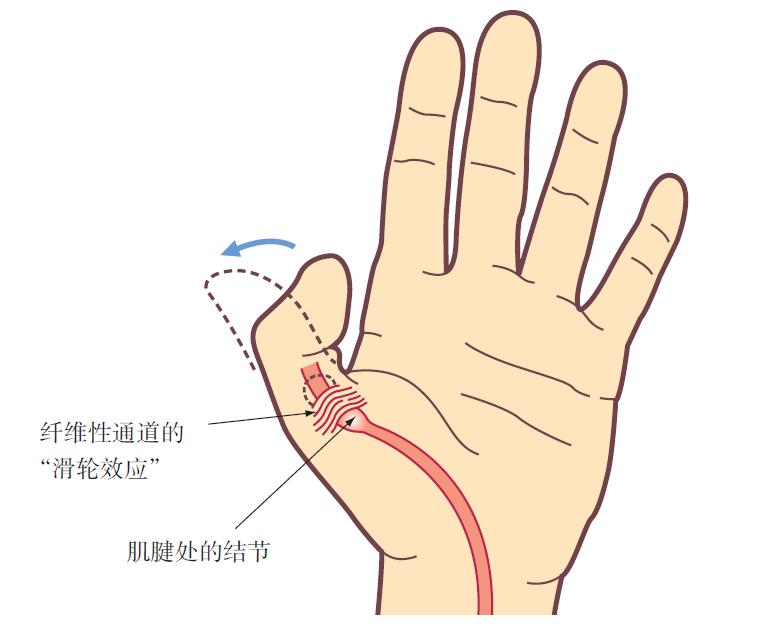 扳机指一针疗法,扳机指治疗穴位