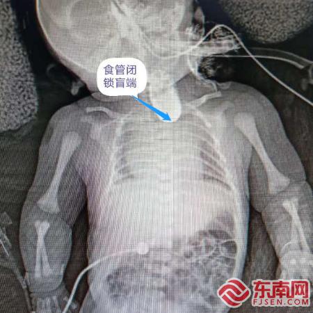 漳州新生儿先天性食道闭锁,先天性食道闭锁宝宝